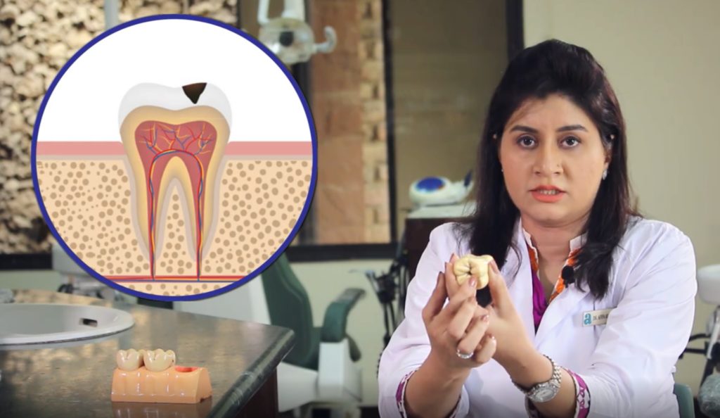 Dental Cavities – دانتوں کا کیرا