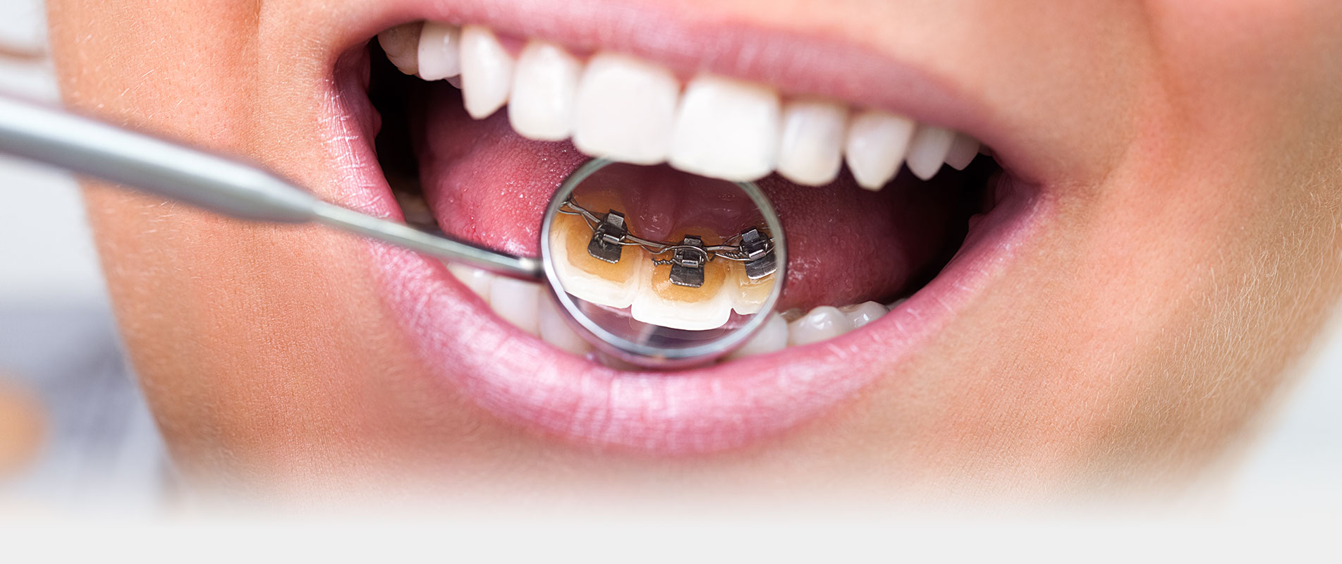Lingual Braces — Alternative to Normal Braces but Behind Your Teeth