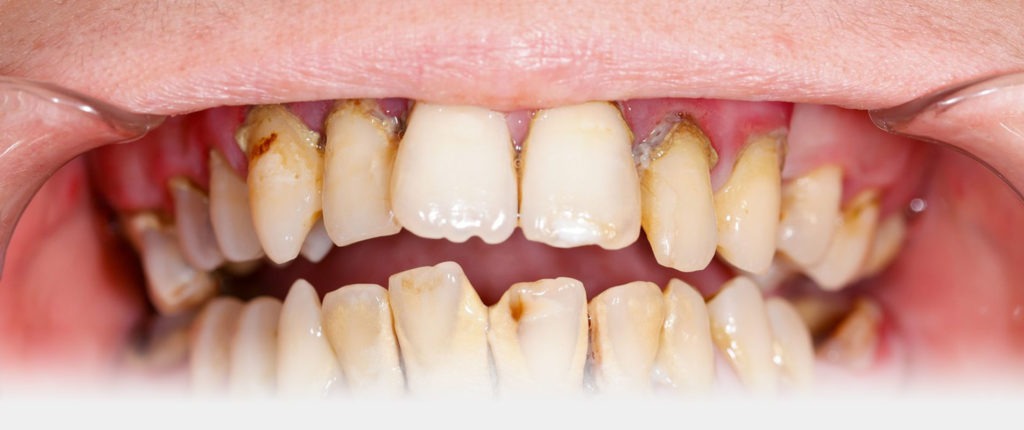 Gum Disease