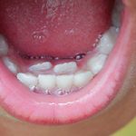 Extra Teeth in Children - Shark Teeth
