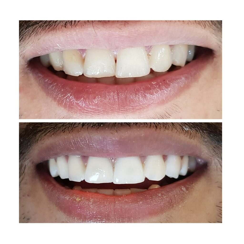 Tooth Whitening — Laser Whitening many Shades Lighter in 30 min