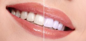 Before After Laser Tooth Whitening
