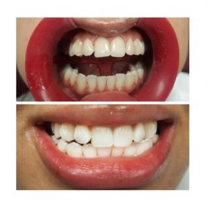 Laser Whitening Alvi Dental