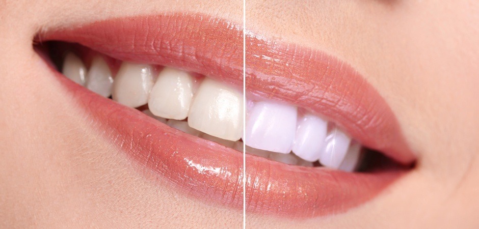 Tooth Whitening — Laser Whitening many Shades Lighter in 30 min