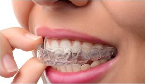 aligner image of girl wearing braces karachi transparent